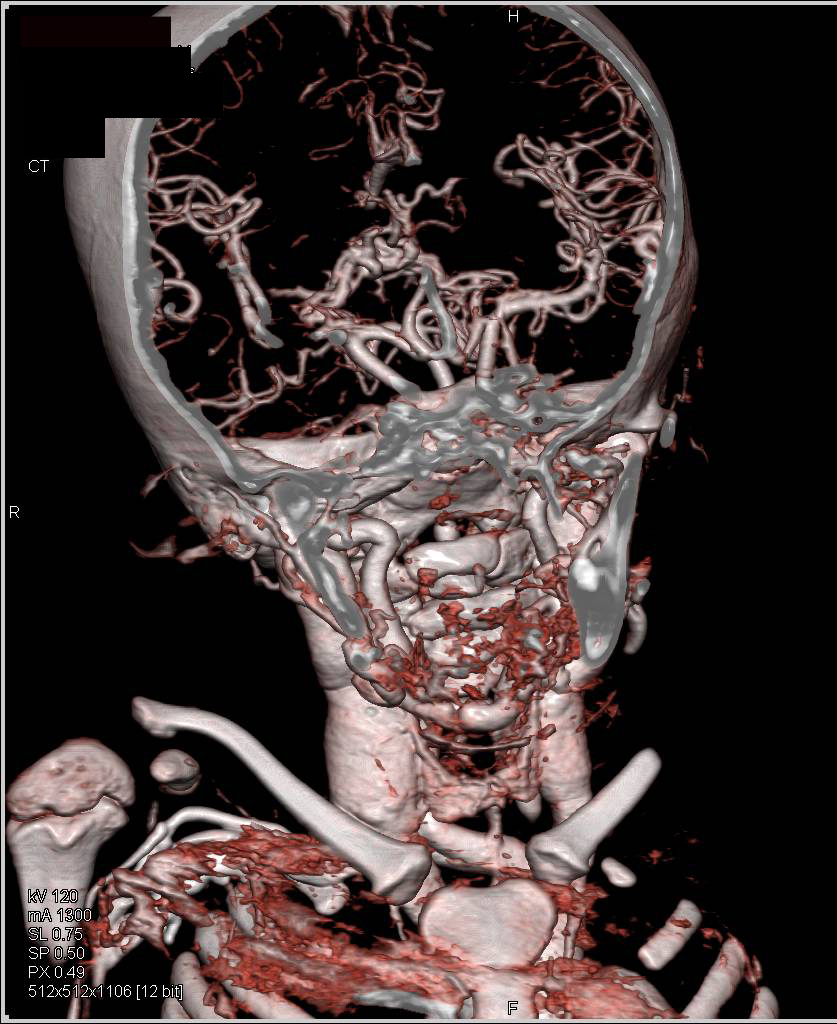 Ectatic Carotid Arteries in Loeys-Dietz Syndrome - CTisus CT Scan