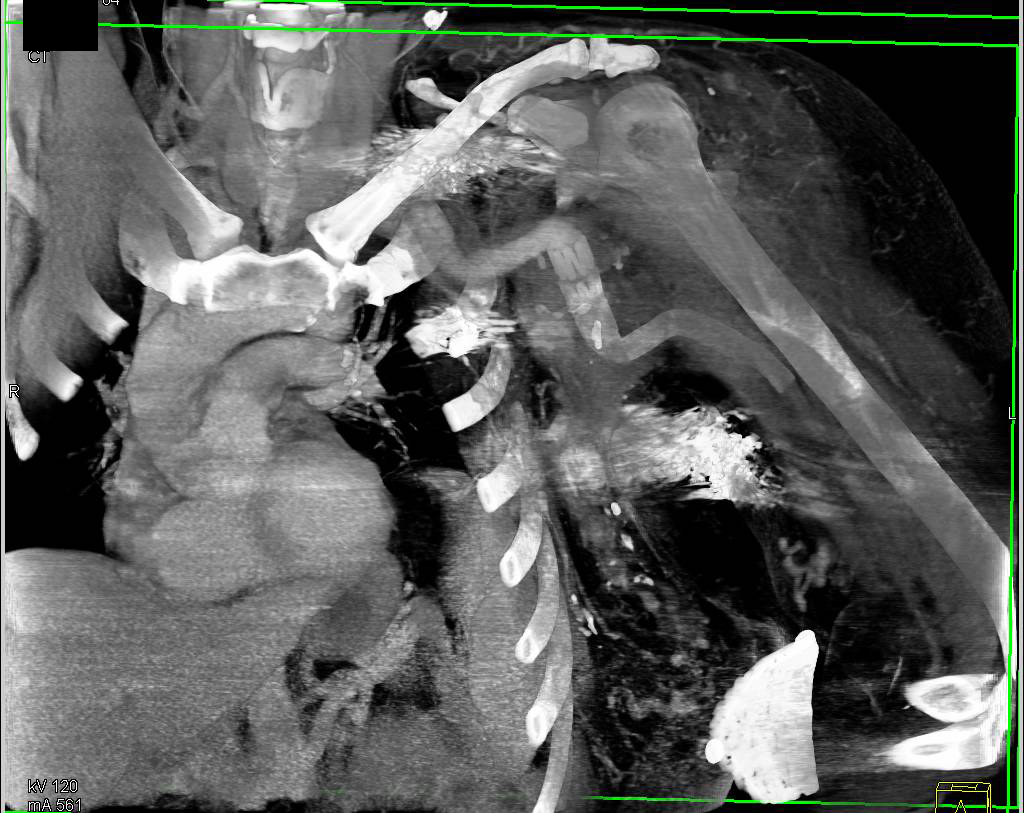 Patent Stent in Left Axillary Artery - CTisus CT Scan