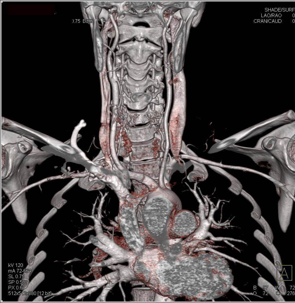 CTA of the Neck - CTisus CT Scan