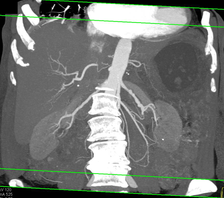 Fibromuscular Dysplasia of the Renal Artery (FMD) - CTisus CT Scan
