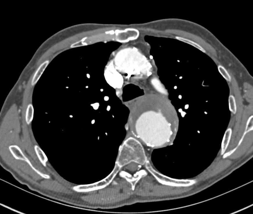 Aortic Aneurysm with Endovascular Stent and Endoleak - CTisus CT Scan
