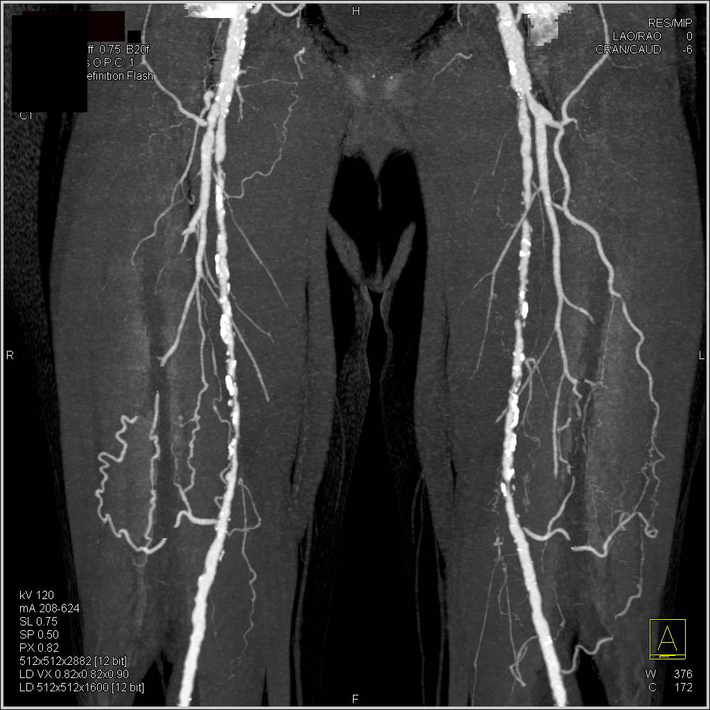 CTA Runoff of Peripheral Vascular Disease with Multiple Superficial Femoral Artery (SFA) Stenosis - CTisus CT Scan
