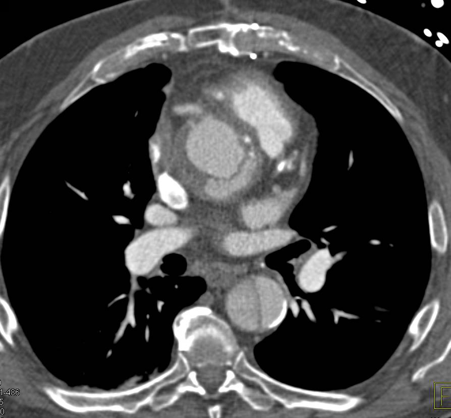 Type A Dissection - CTisus CT Scan
