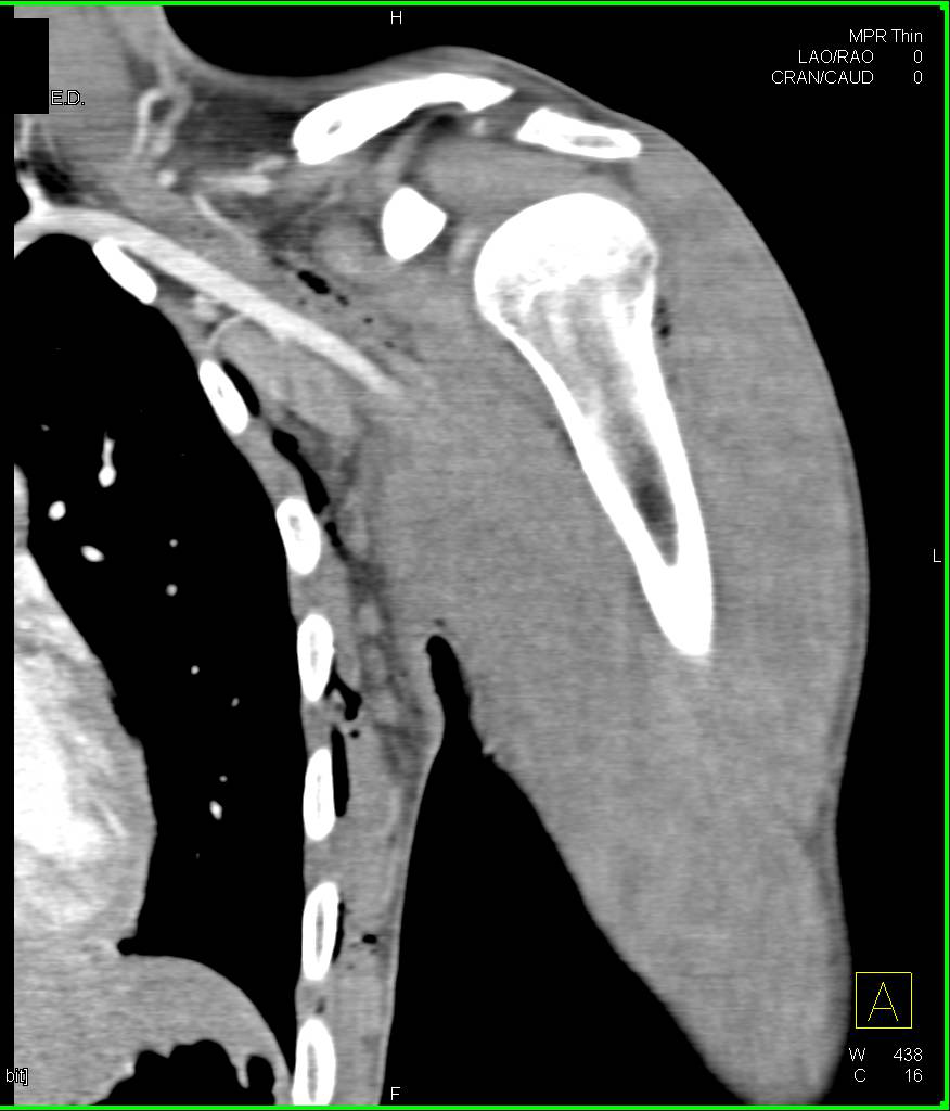Gunshot Wound Shoulder without a Vascular Injury - CTisus CT Scan