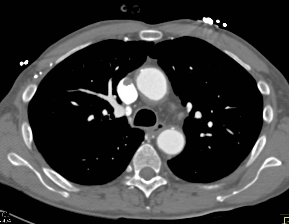 Superior Vena Cava (SVC) thrombus - CTisus CT Scan