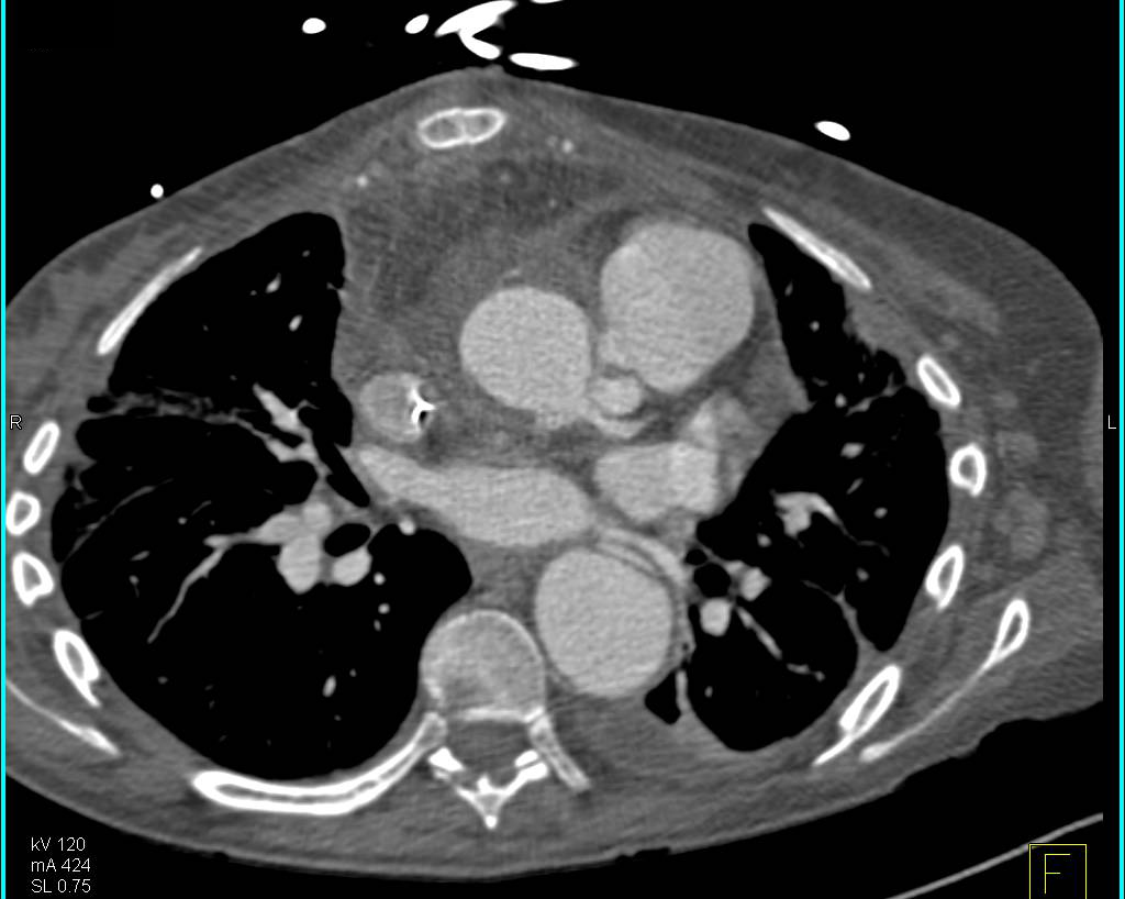 Elephant Trunk Repair of Aortic Arch with 