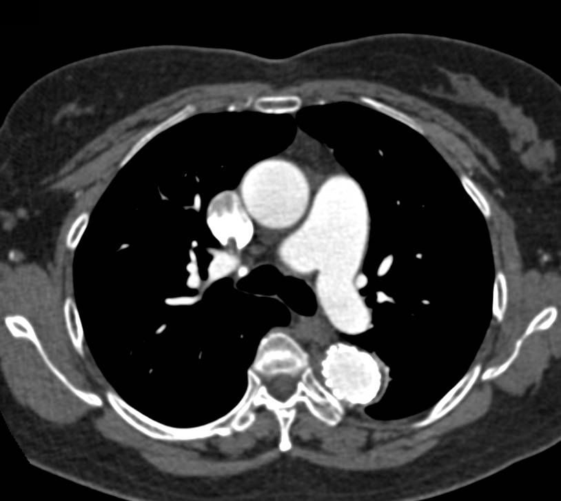 Endovascular Stent in Descending Thoracic Aorta Shown with Vessel Analysis - CTisus CT Scan