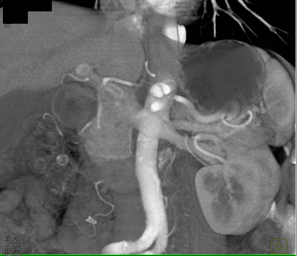 Celiac Artery Dissection - CTisus CT Scan