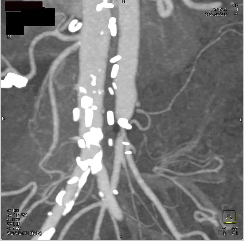 Reimplanted Superior Mesenteric Artery (SMA) with Distal Stenosis - CTisus CT Scan