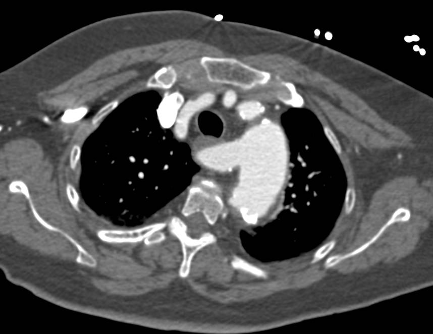 Ulceration Descending Aorta with Intramural Hematoma as well as Aberrant Right Subclavian Artery - CTisus CT Scan