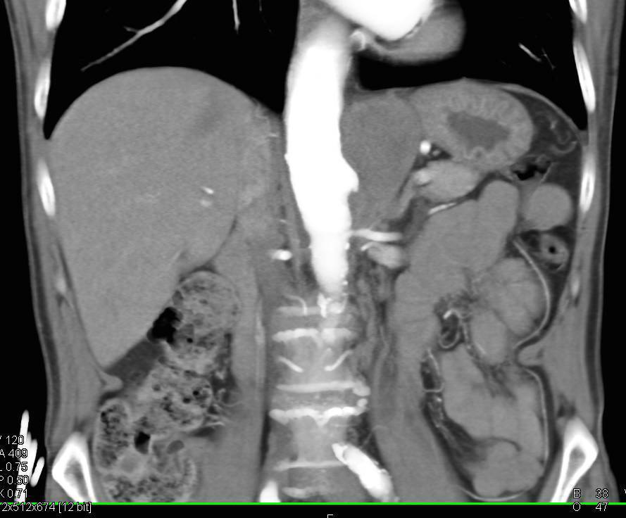 Ulceration Descending Aorta with Intramural Hematoma (IMH) - CTisus CT Scan