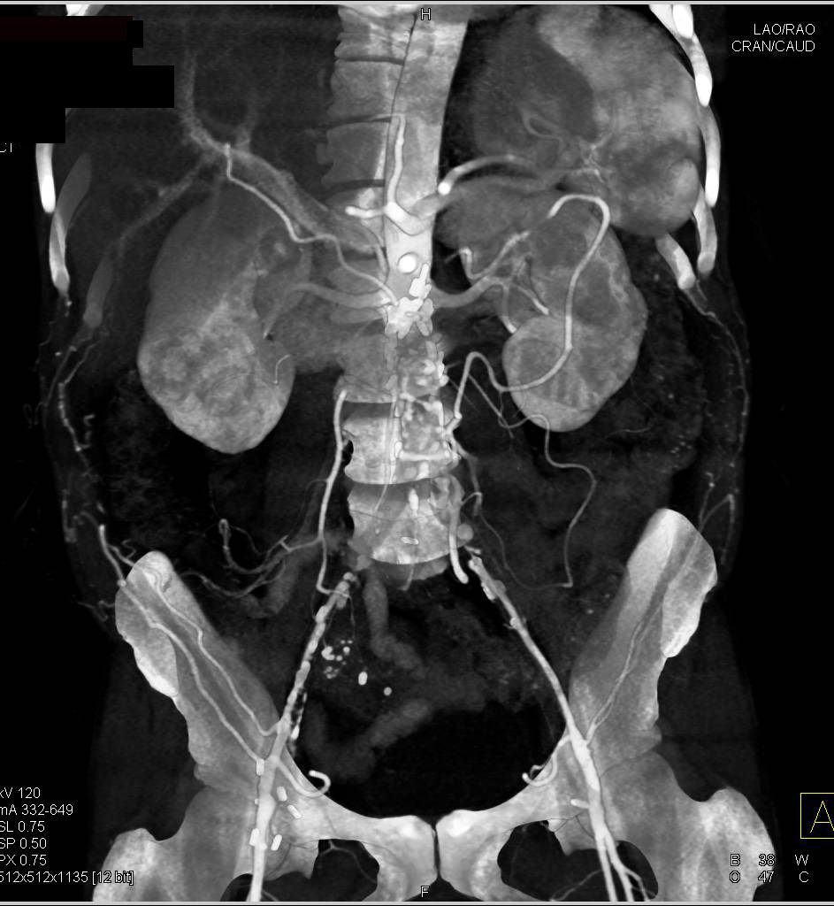 Aortic Occlusion with Flow Through Lumbar Arteries Reconstitutes External Iliac Artery Opacification - CTisus CT Scan