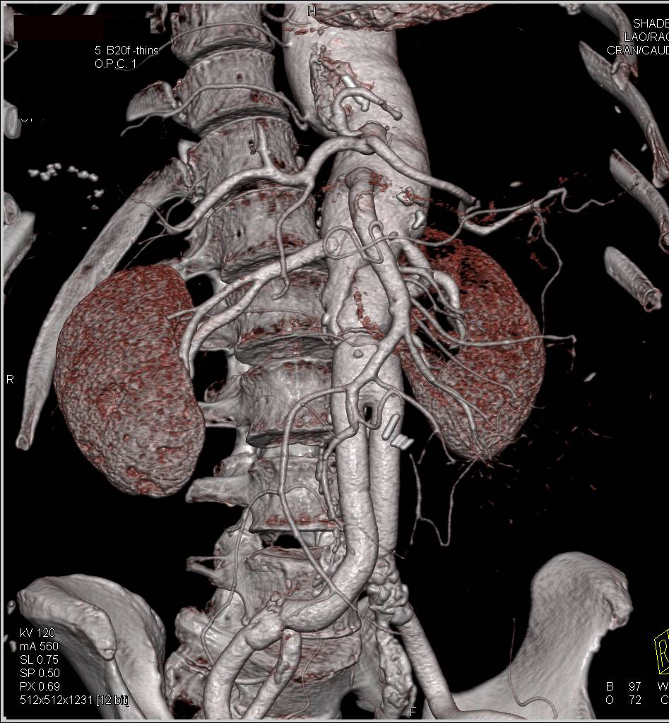 Repair Ascending Aorta as well as Abdominal Aorta with Dissection in the Arch Defined - CTisus CT Scan