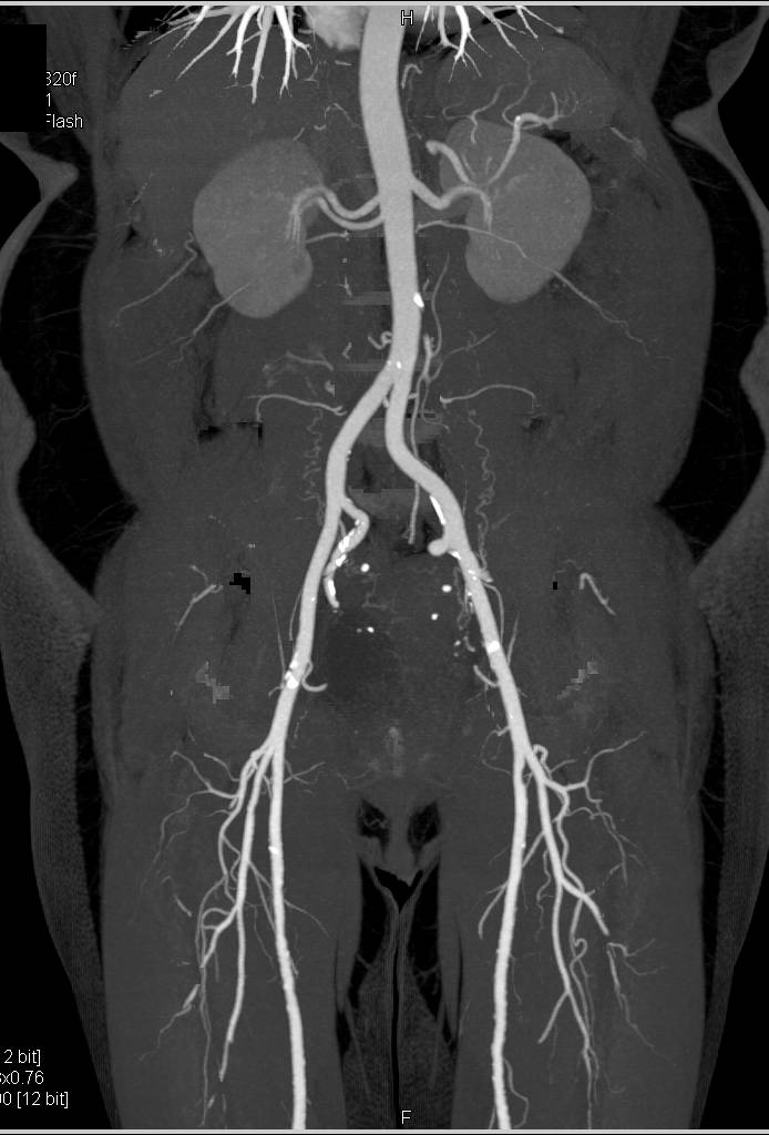 CTA Runoff with Peripheral Vascular Disease (PVD) and Disease Best Seen in the Peroneal Artery - CTisus CT Scan