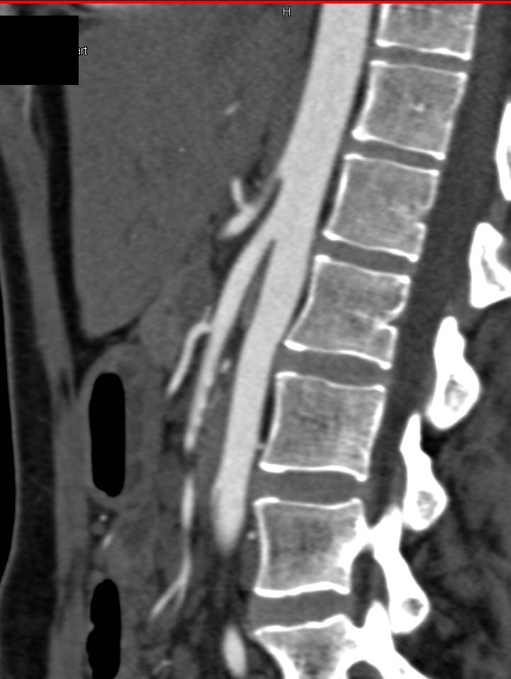 Superior Mesenteric Artery (SMA) Syndrome Defined on Multiple Views - CTisus CT Scan