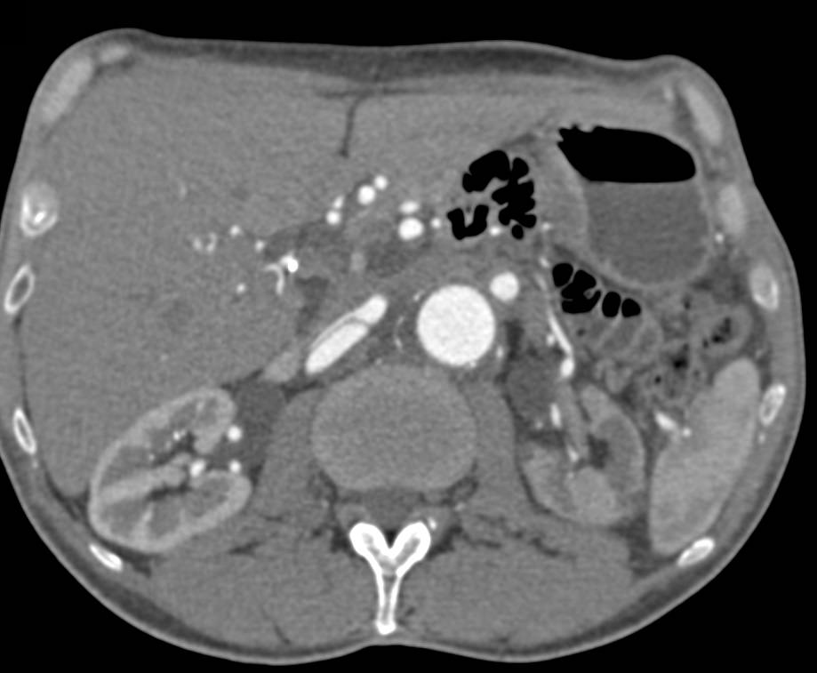 Reimplanted Left Renal Artery in Patient with Aortic Aneurysm Repair. the Left Kidney has Decreased Function - CTisus CT Scan