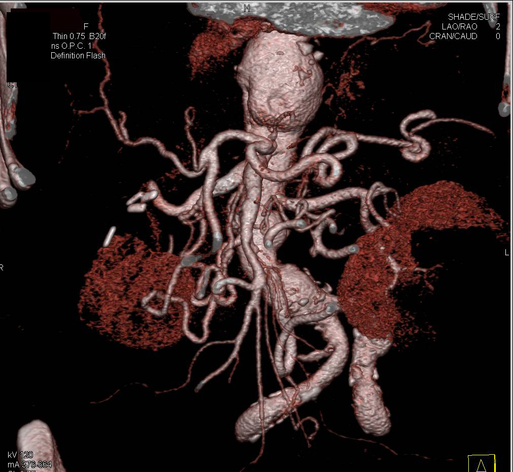 Aortic Aneurysm with Stenosis of Origin of the Celiac Artery, Superior Mesenteric Artery (SMA) and IMA - CTisus CT Scan