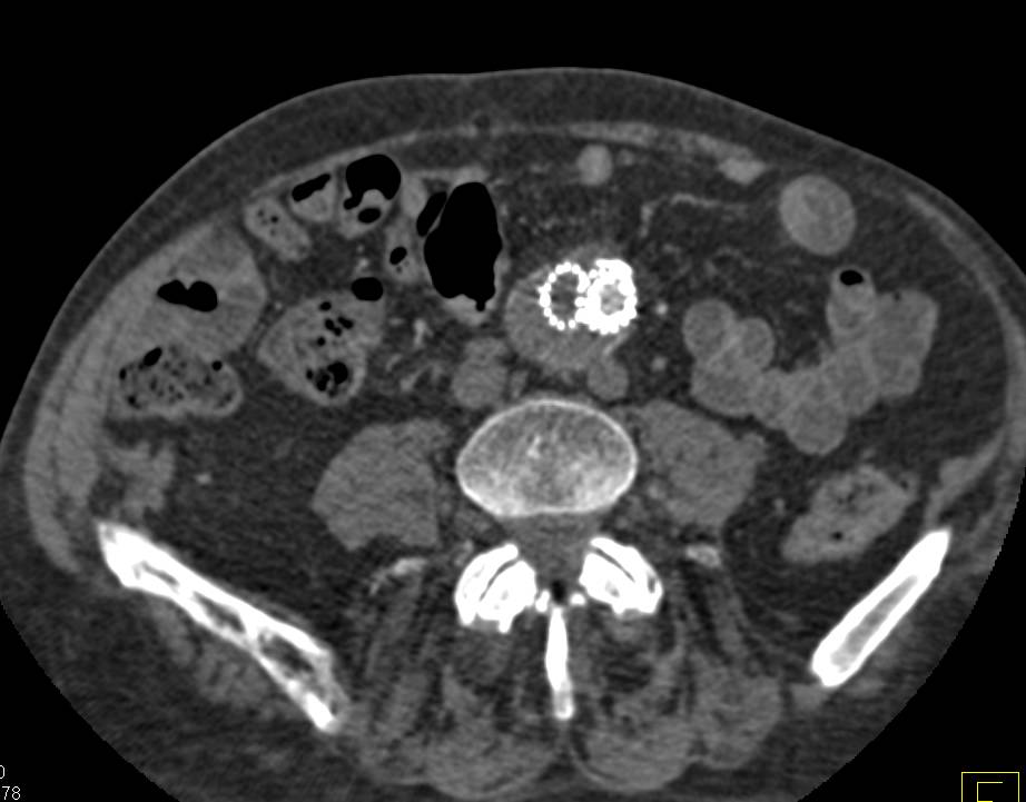 Endovascular Stent withFlow Also Through a Fem-Fem Bypass Graft - CTisus CT Scan