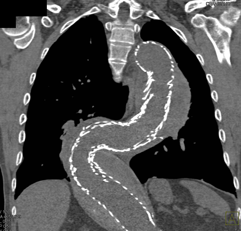 Endovascular Stent with Endoleak - CTisus CT Scan