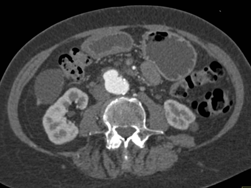 Abdominal Aortic Aneurysm and Focal Dissection - CTisus CT Scan