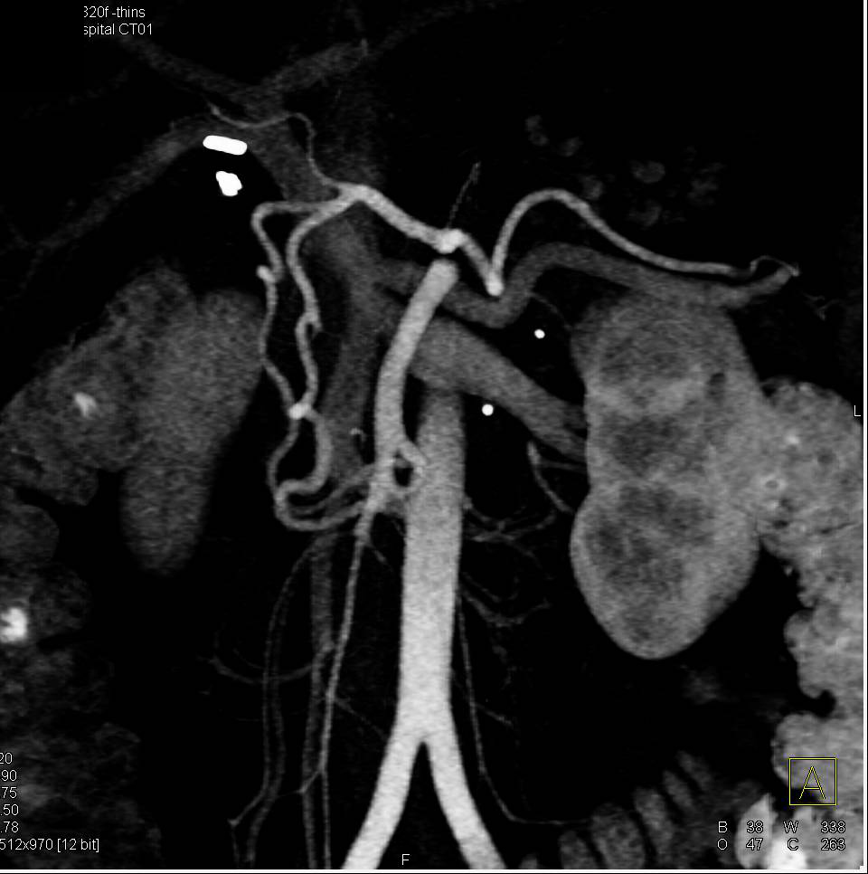 Median Arcuate Ligament Syndrome (MALS) - CTisus CT Scan