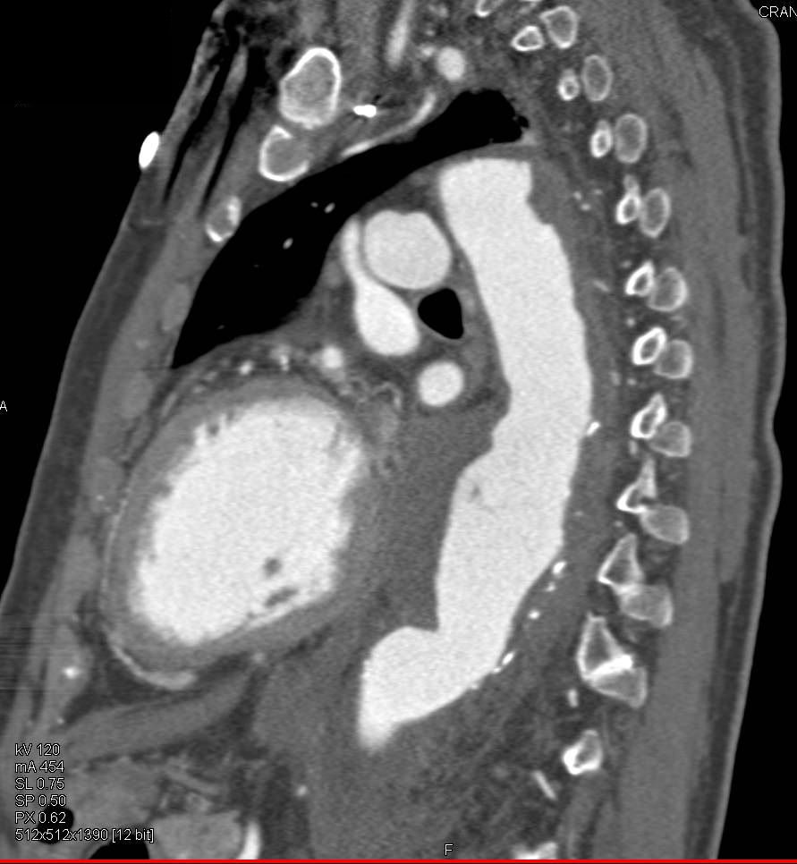 Large Aneurysm Descending Thoracic Aorta with Ulcerations and Inramural Hematoma - CTisus CT Scan