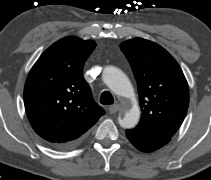 Thrombus Seen in the Aortic Arch - CTisus CT Scan