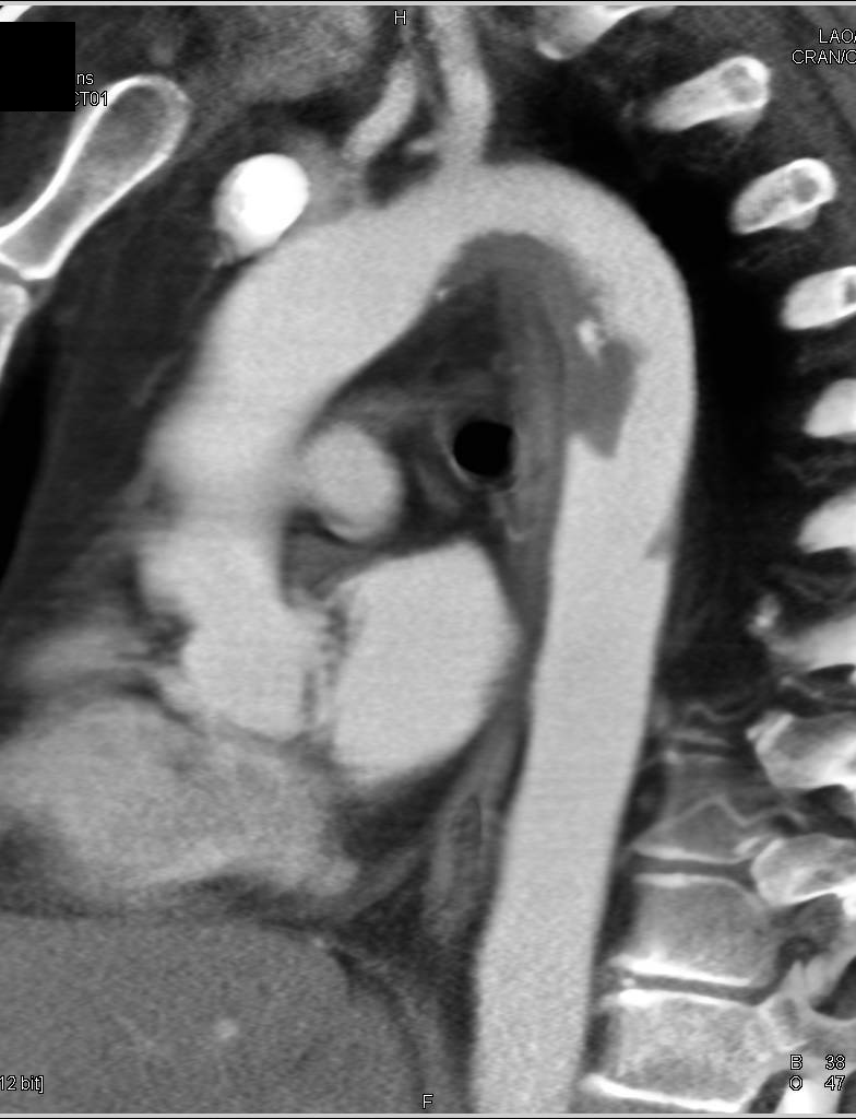 Clot in the Thoracic Aorta - CTisus CT Scan