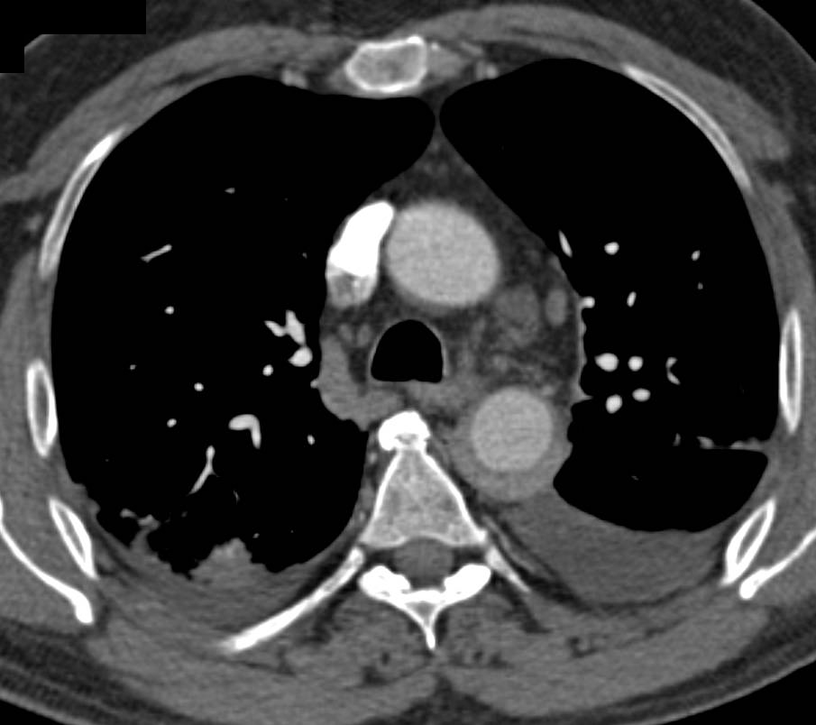 Intramural Hematoma in 3D - CTisus CT Scan