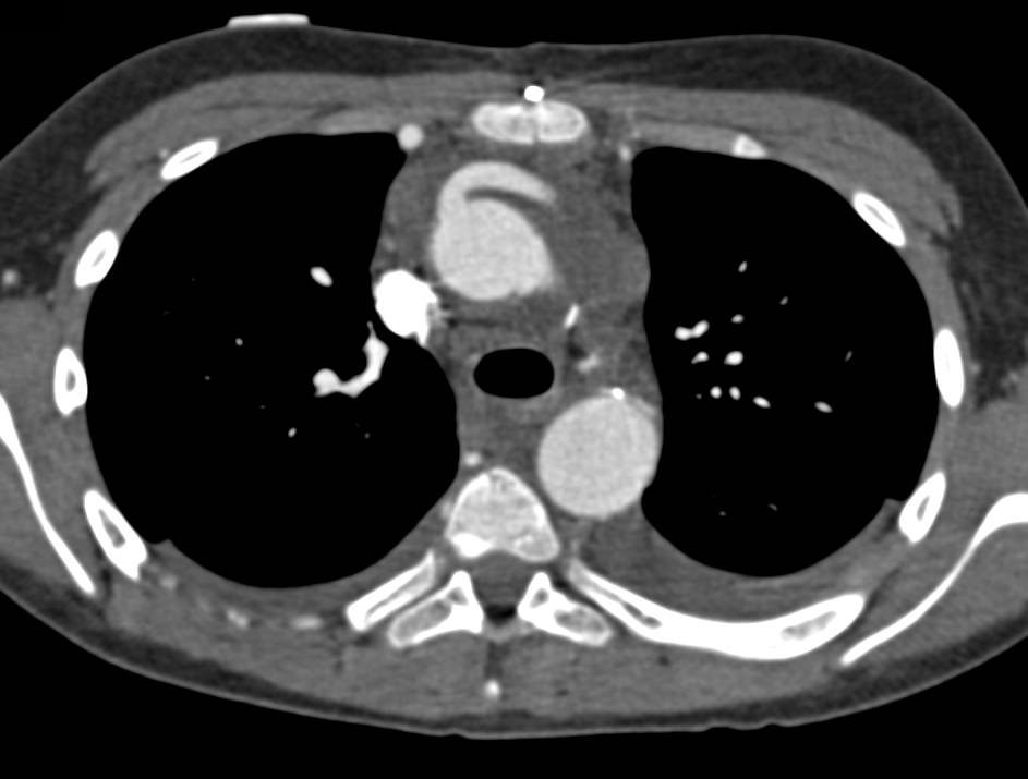 Aortic Aneurysm with Reconstruction of the Thoracic Aorta as well as Bypass Grafts - CTisus CT Scan