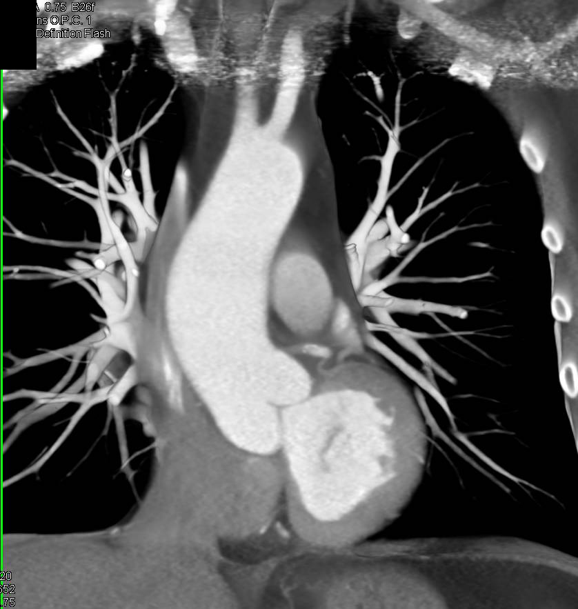 Dilated Ascending Aorta with 3D Mapping - CTisus CT Scan