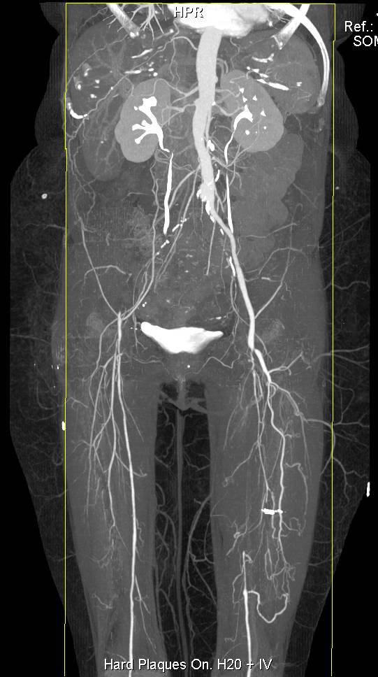 Runoff with Dual Energy and Multiple Stenosis Done with Plaque Removal - CTisus CT Scan