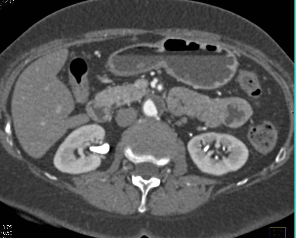 CTA Runoff with Occlusion of the Right Common Iliac Artery and Left Superficial Femoral Artery - CTisus CT Scan