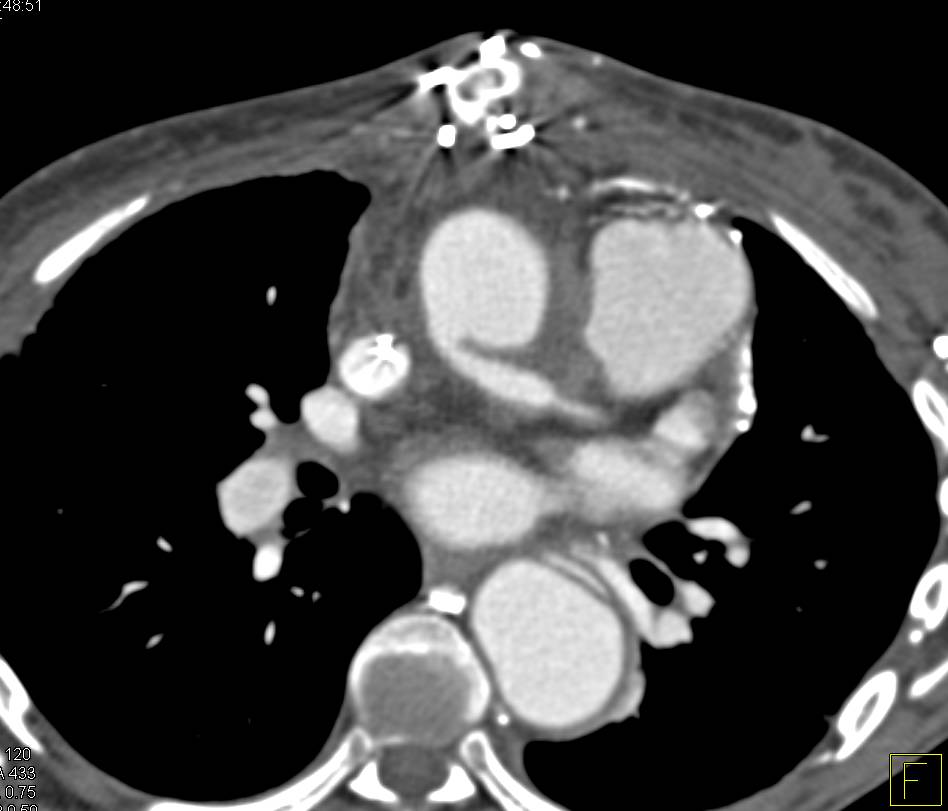 Aortic Dissection with Repair of Ascending Aorta with Dissection in Descending Aorta Still Present - CTisus CT Scan