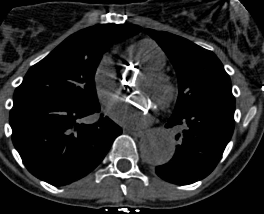 Multiple Vascular Surgeries in 3D Include Aortic Valve Replacement (AVR),MVR, Superior Mesenteric Artery (SMA) Stent, Right Renal Artery Stent - CTisus CT Scan
