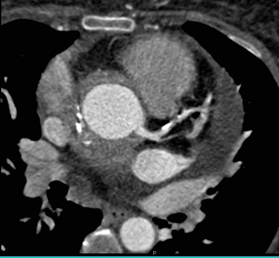 CTA with 3D Mapping of an Aortic Root Repair - CTisus CT Scan