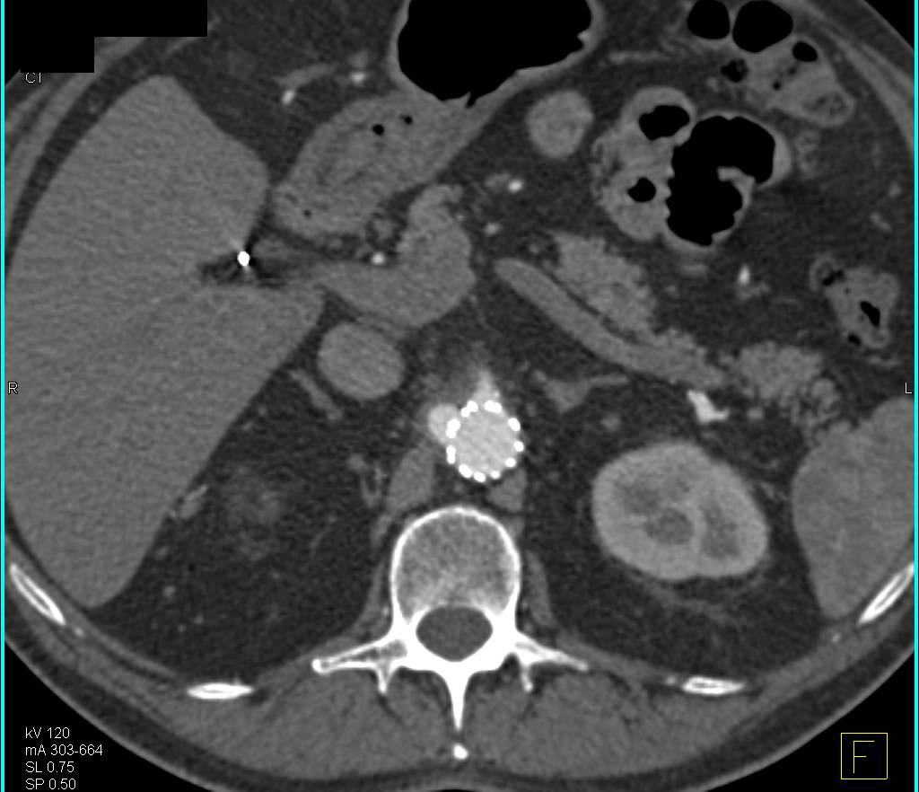 Endovascular Stent with Fem-Fem Bypass and Occlusion of an Iliac Limb as Well as Endoleak - CTisus CT Scan