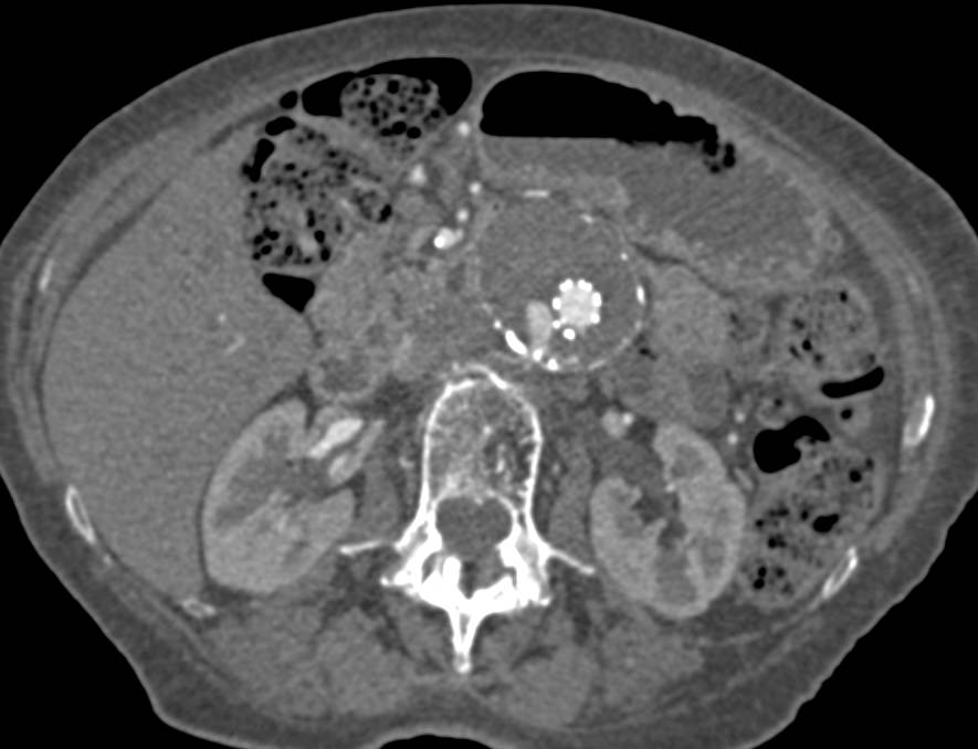 CTA of Abdominal Aortic Aneurysm (AAA) Repair with Endovascular Stent and Fem-Fem Bypass. Leak in Endovascular Stent Seen on Early and Late Phase Images - CTisus CT Scan