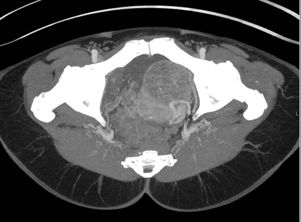 Pelvic Perforators for FLAP Surgery - CTisus CT Scan