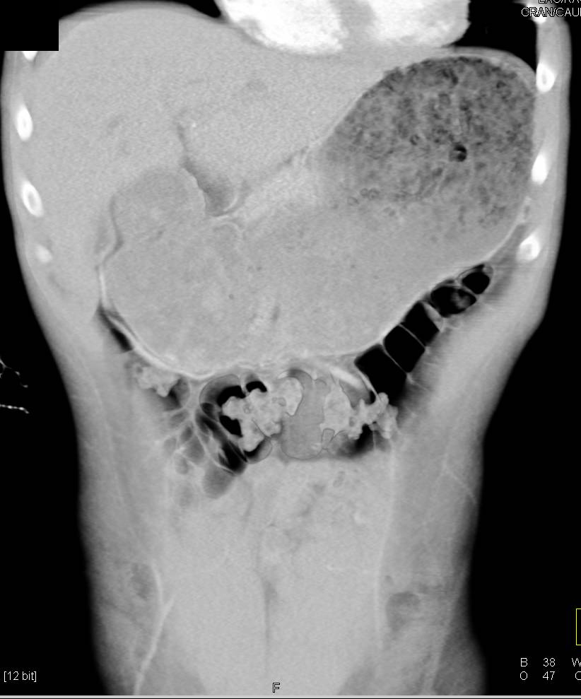 Aortic Aneurysm with Extensive Plaque - CTisus CT Scan