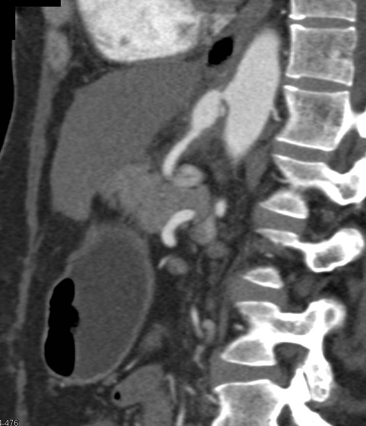 Celiac Artery Aneurysm - CTisus CT Scan
