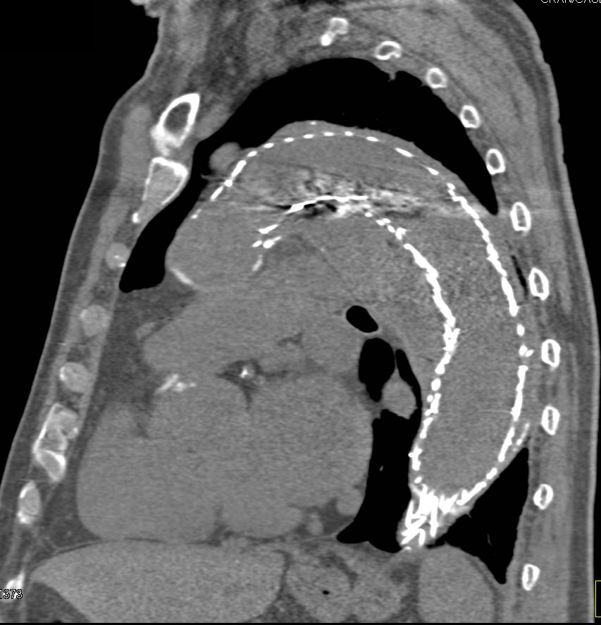 Endovascular Stent with Large Endoleak in Thoracic Aorta - CTisus CT Scan