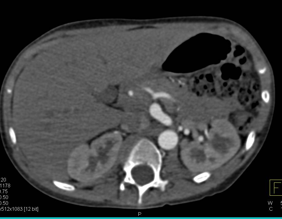 Tortuous Artery Syndrome with Celiac Artery Aneurysm - CTisus CT Scan