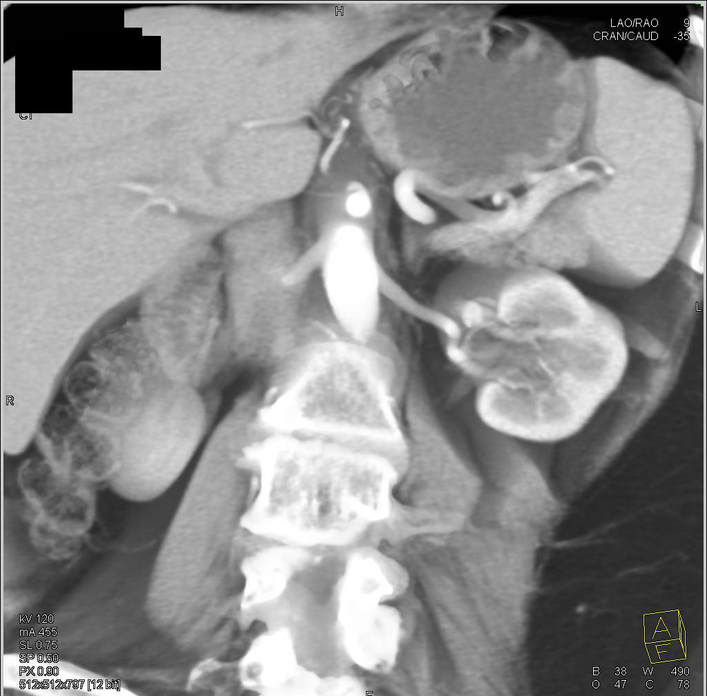 Circumaortic Left Renal Vein - CTisus CT Scan
