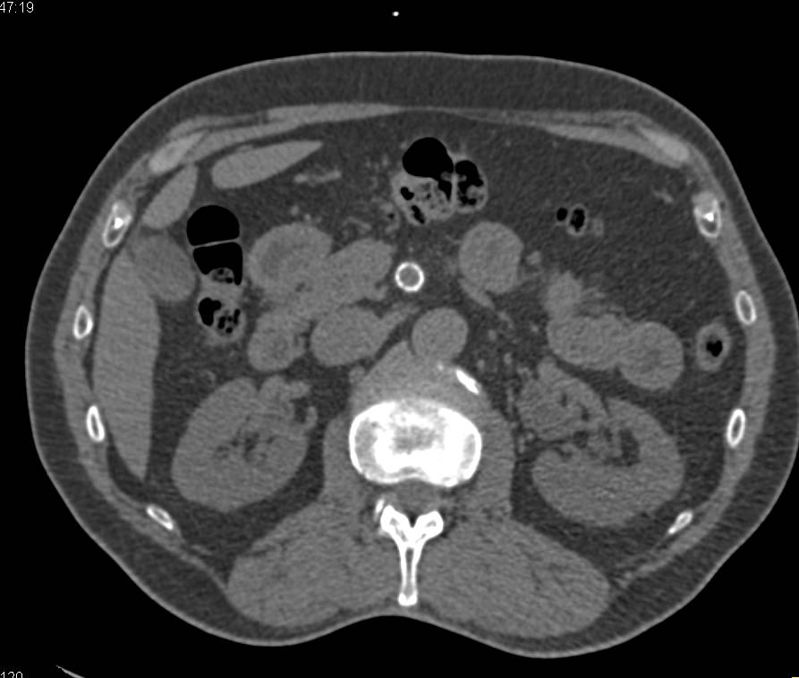 Stents in Celiac and Superior Mesenteric Artery (SMA) Which Are Patent in 3D Display - CTisus CT Scan