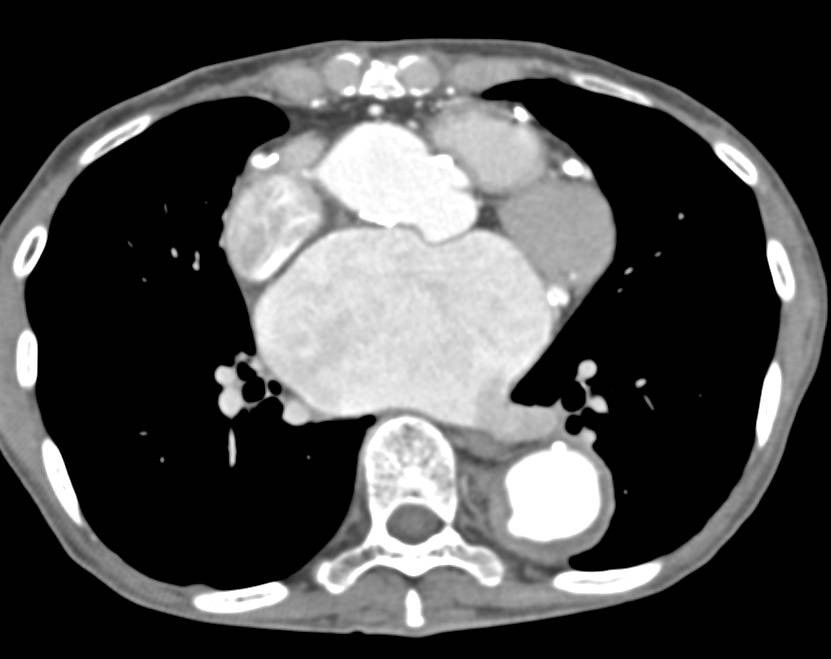 Aortic Aneurysm with Incidental Occlusion of Proximal Celiac Axis - CTisus CT Scan
