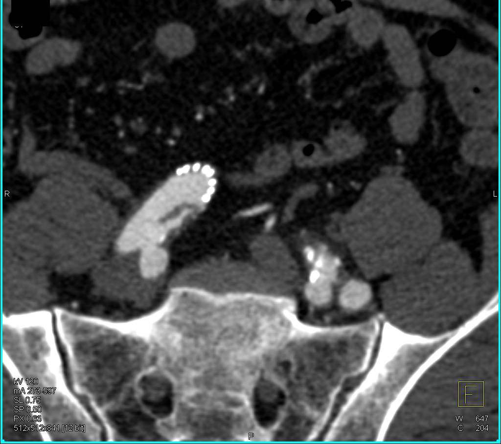 Right Common Iliac Artery Dissection in Patient with Endovascular Stent in Place - CTisus CT Scan