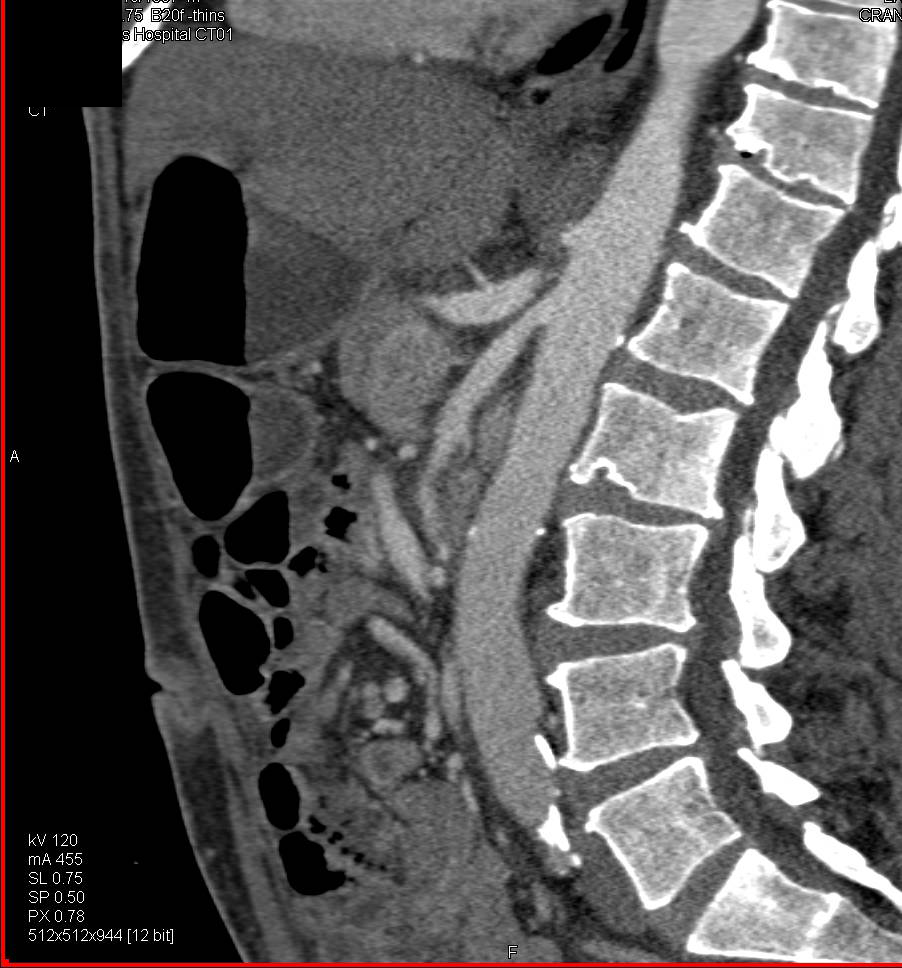 Subtle and Mild Superior Mesenteric Artery (SMA) Syndrome Based on Angle Measurement - CTisus CT Scan