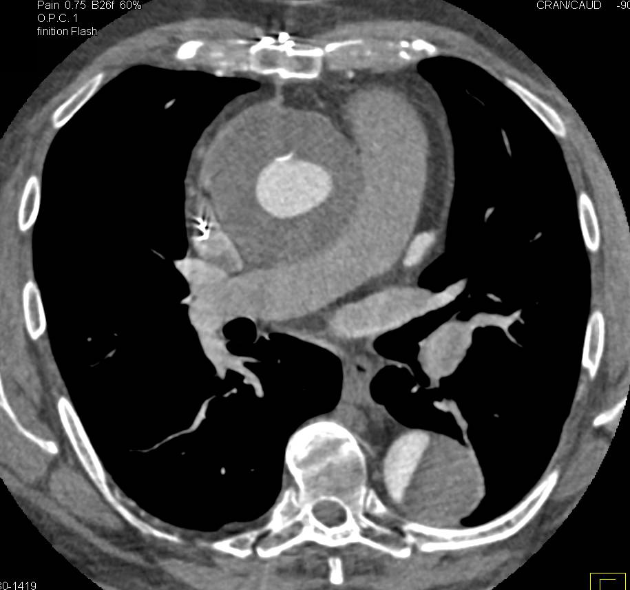Ascending Aortic Aneurysm Repair with Type A Dissection - CTisus CT Scan