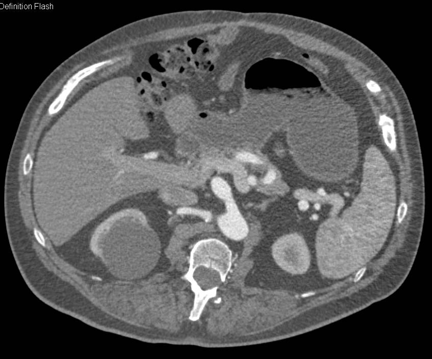Ehlers-Danlos Syndrome with Celiac Aneurysm and Bilateral Popliteal Artery Aneurysms - CTisus CT Scan